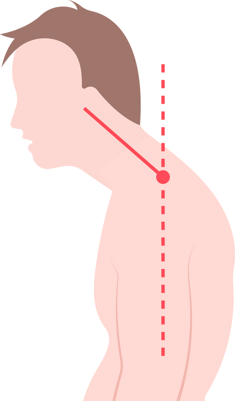 Text neck dowager's  woman head cushing's syndrome pain spine back cervical weight cyst tumor loss adrenal gland bad fat lipoma phone